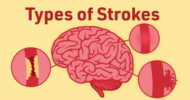 Designed for Every Stage of Stroke Recovery — 1 Month to 10+ Years